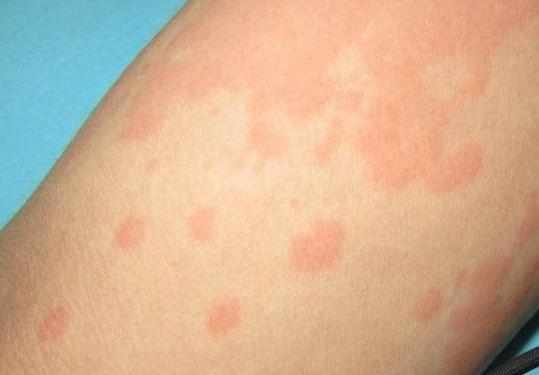 吃螃蟹喘不上来气怎么办,吃了螃蟹喘不上气