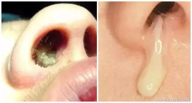 清鼻涕浓稠,清鼻涕小妙招婴儿