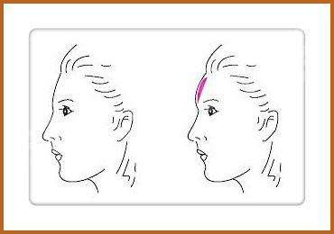 注射玻尿酸的危害图片,注射玻尿酸有害吗