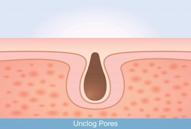 怎么可以缩小鼻子黑头,鼻子大黑头怎么挤出来