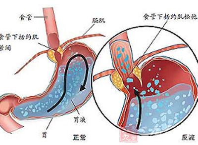儿童不停的咳嗽最快的见效药,儿童慢性咳嗽的诊断及治疗