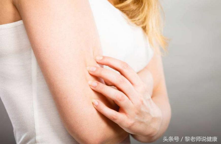 遇热性荨麻疹要吃什么中药效果好,荨麻疹吃了药后怎么预防