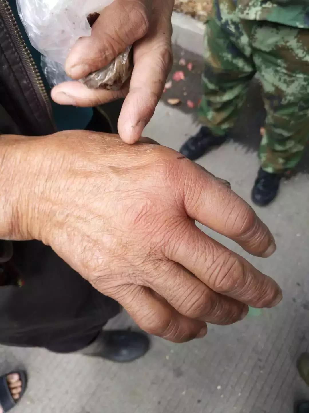 七旬老人被马蜂蛰伤害,老人要是被马蜂蛰了应该怎么治