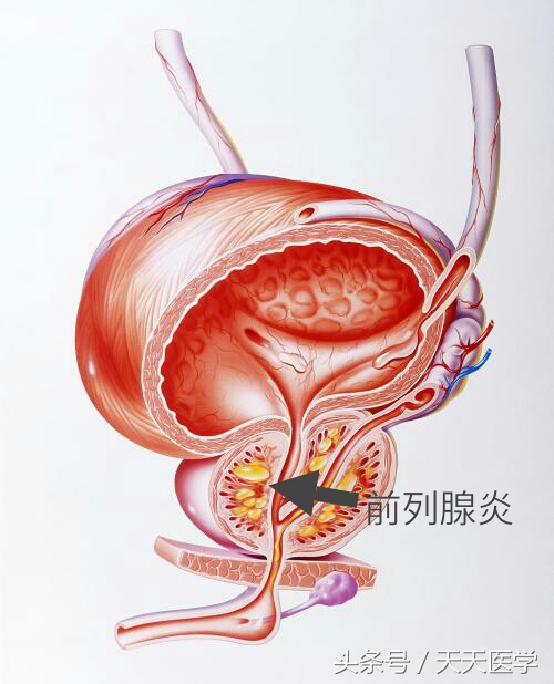 良性前列腺增生怎么治疗好得快,良性前列腺增生怎么治疗最有效