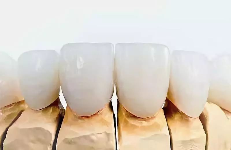 烤瓷牙与全瓷牙价格相差多少,烤瓷牙和全瓷牙价格差多少钱