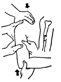 中医骨折治疗原则,中医骨伤整复术