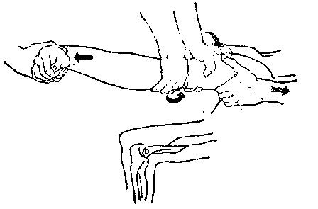 中医骨折治疗原则,中医骨伤整复术