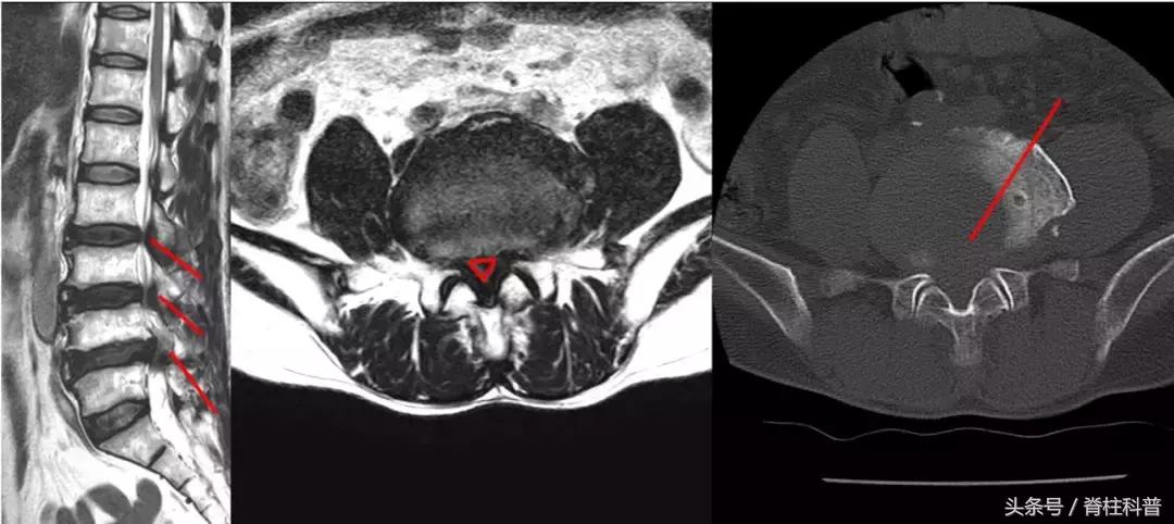 腰腿疼的防治误区,腰腿侧边疼怎么自测