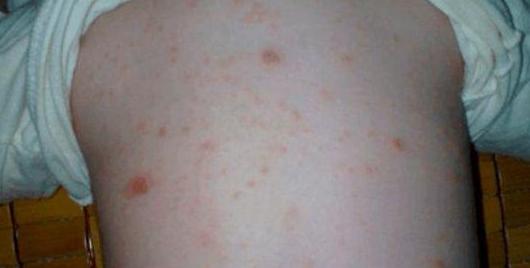 孩子发烧千万不要随便退烧,孩子发烧不要急着去医院