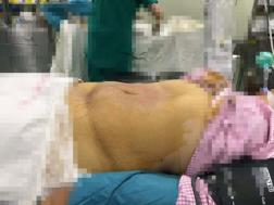 15岁少年腹中20公斤巨瘤,39岁女子腹中30斤巨型肿瘤