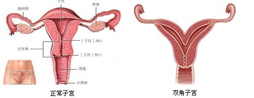 子宫畸形与怀孕——双角子宫与纵隔子宫