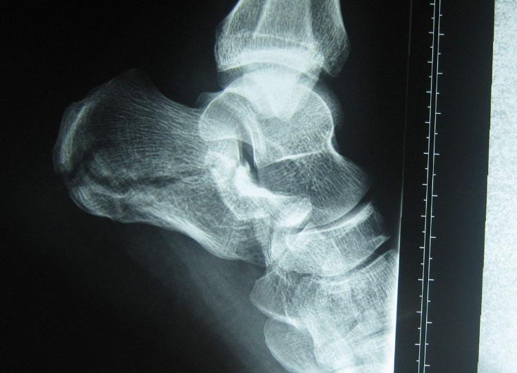 脚后跟长骨刺非常痛应该怎么治疗,脚后跟长骨刺了特别疼怎么治疗