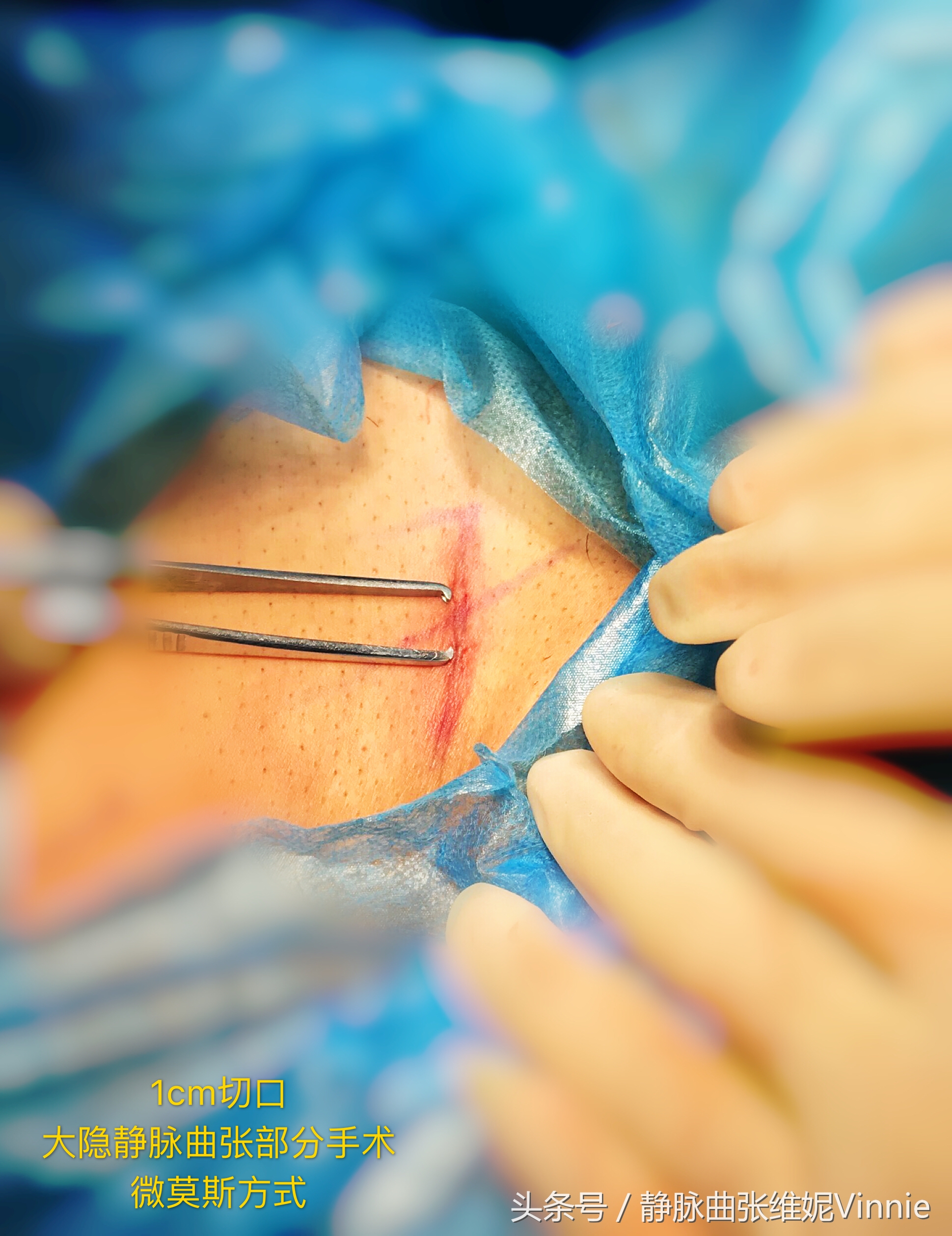 下肢浅静脉曲张最佳治疗方案,当前下肢静脉曲张治疗的最佳方法