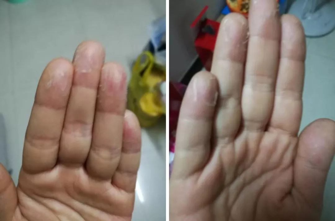 孩子手起水泡脱皮痒怎么办,孩子手脱皮且有臭味怎么回事