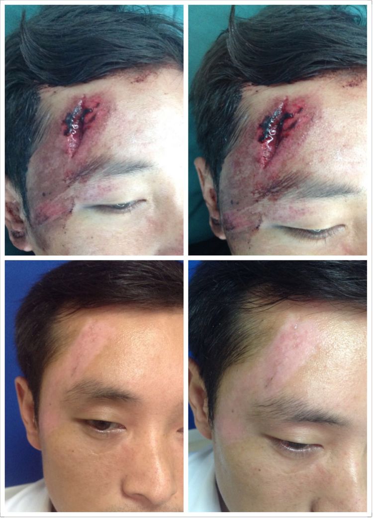 面部外伤后初期疤痕凸起怎么修复,面部外伤凹陷疤痕怎么去除