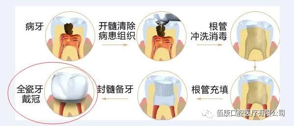 根管治疗的步骤有哪些,根管治疗全过程步骤视频