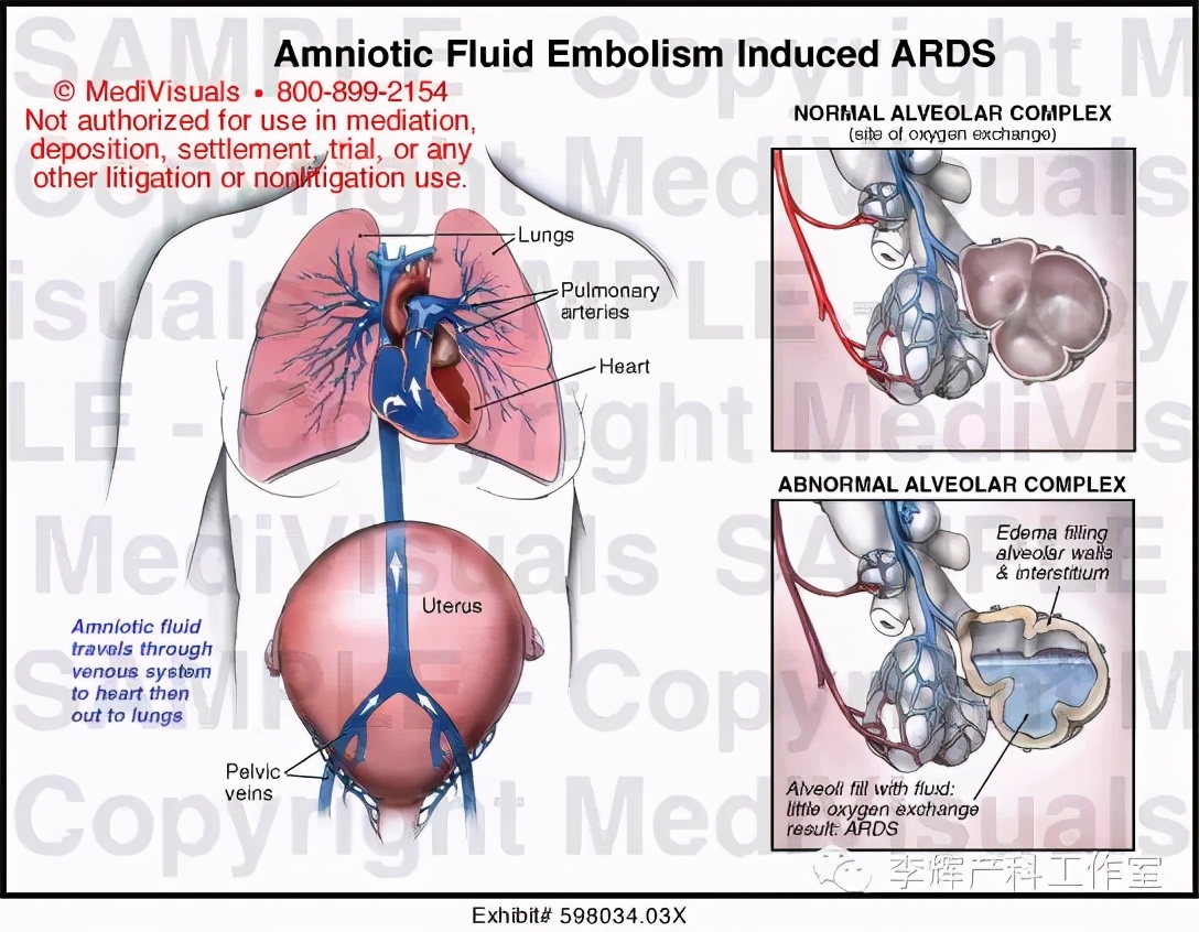 剖宫产憩室手术知情同意书,剖宫产手术同意书