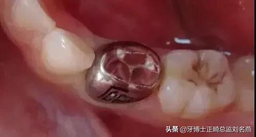 乳牙预成冠的功效与作用,儿童乳牙预成冠一颗多少钱