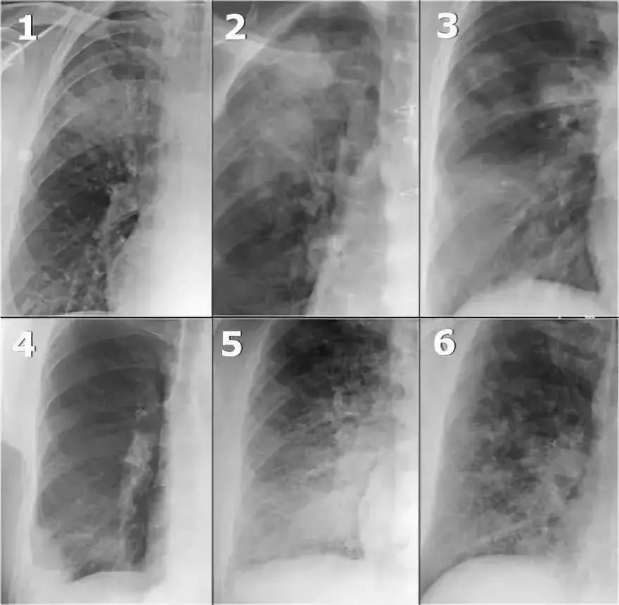 儿童胸片肺实变怎么看,胸病的症状有哪些表现