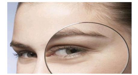 去眼袋术后出现细纹怎样修复,眼袋手术后细纹增加怎么办