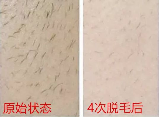 花几千块钱去美容院治痘会好吗,花了数万元购买医美项目