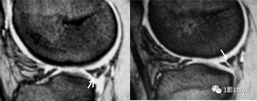 膝关节扭伤做什么检查好,脖子扭伤需要做什么检查