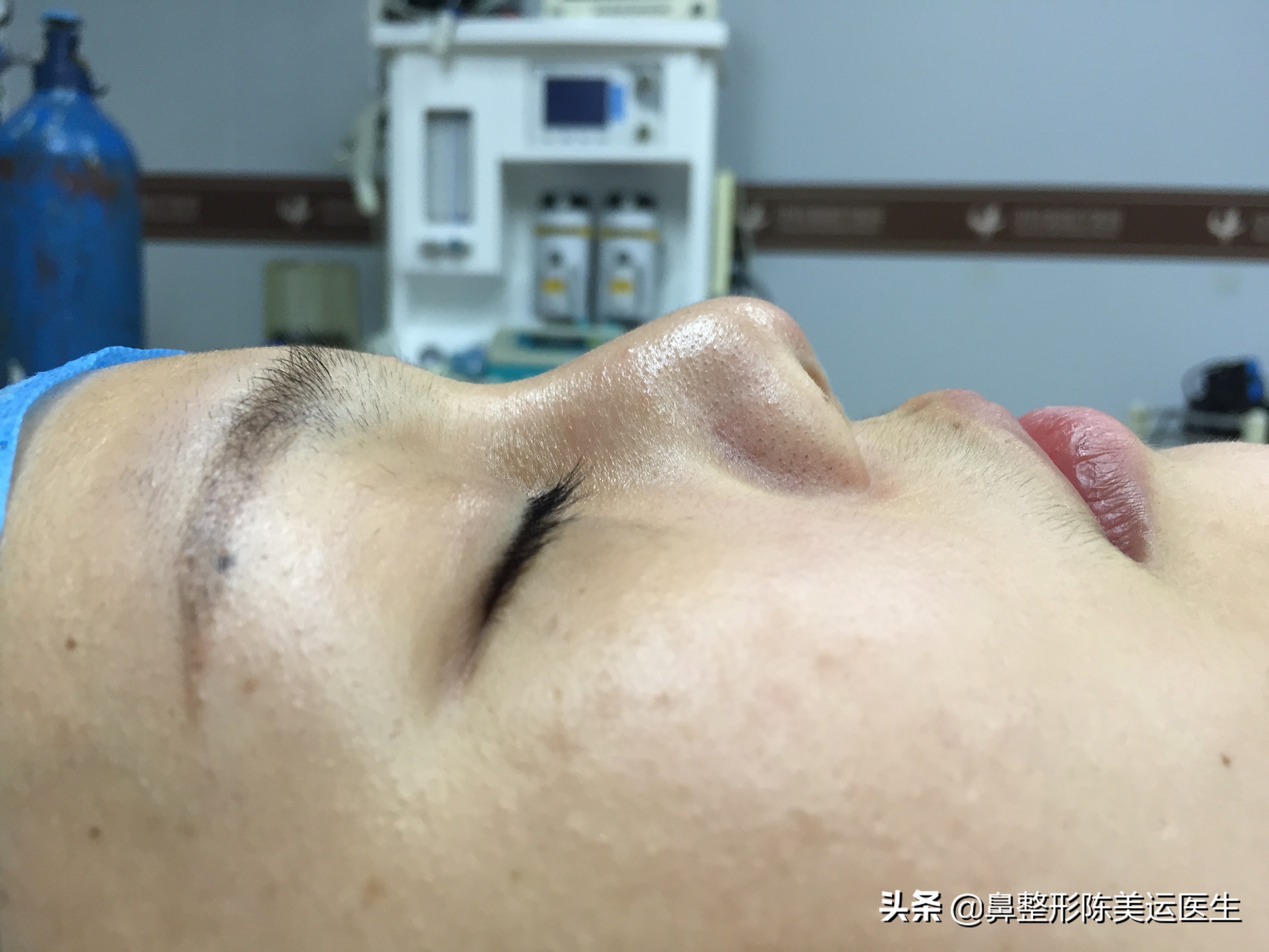 为什么医生都反对线雕隆鼻,到底要不要做线雕隆鼻