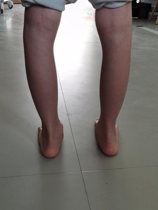 足外翻图片和治疗方法,足外翻需要治疗吗