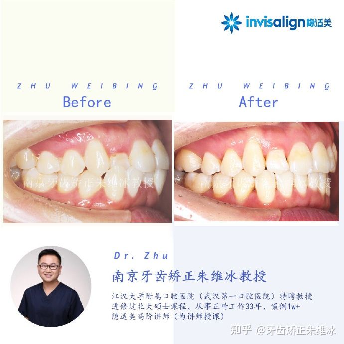 牙齿歪矫正,南京成人牙齿矫正牙齿不齐