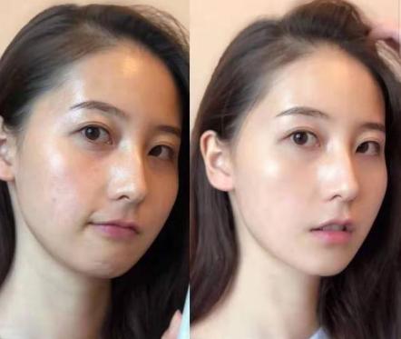 19岁姑娘打溶脂针,女子打美容针脸肿