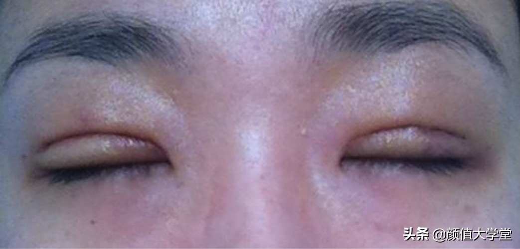 为什么做了双眼皮还不好看,做双眼皮前问清楚自己这三个问题