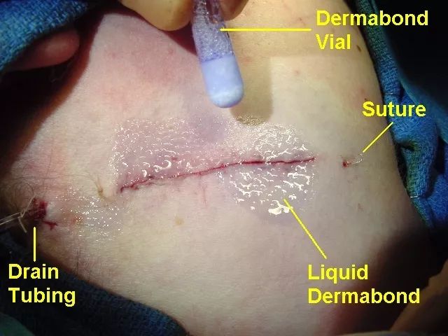 蚂蚁和羊肠是怎么把你和你“缝”在一起的?