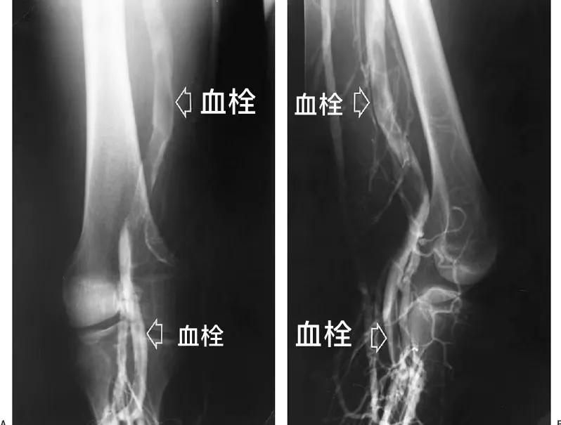 张强医生集团启动静脉血栓“空中门诊”(每日限量提供体验兑换券
