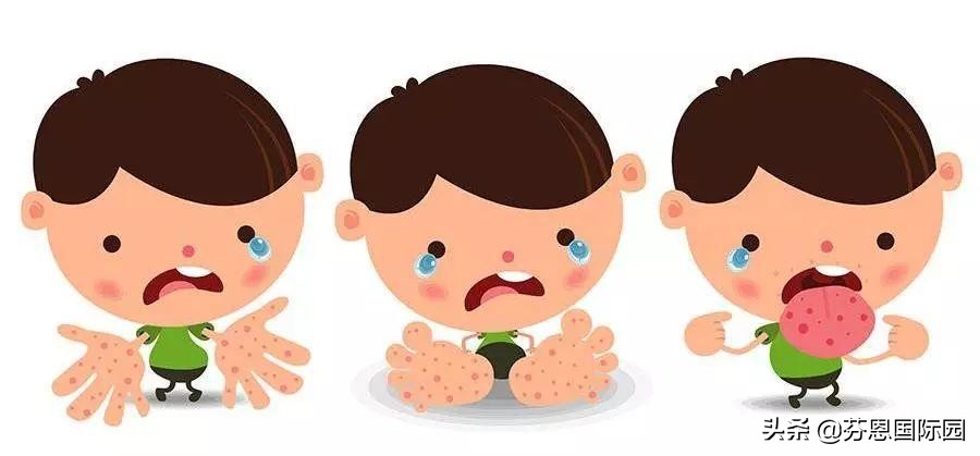 手足口诺如病毒,诺如病毒手足口高发