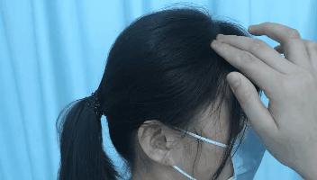 太秃头了怎么办,如何解决头顶秃