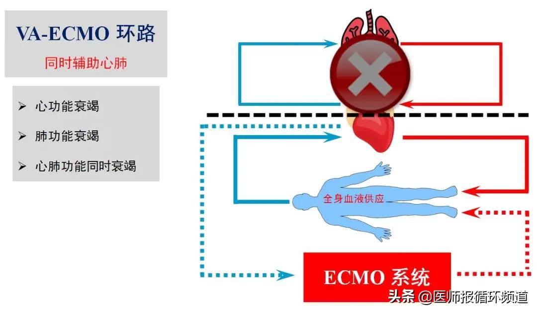 ecmo加重心衰,心衰上ecmo使用什么模式