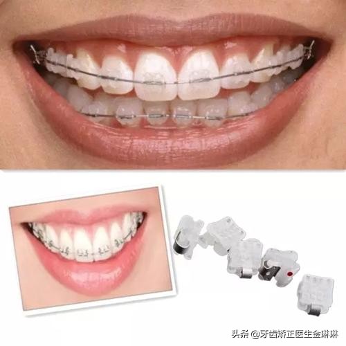 小孩牙齿换牙后长歪了怎么办,小孩子换牙牙齿长歪了怎么办