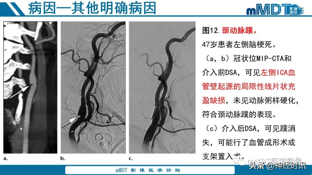 急性缺血性脑卒中ppt素材图片,青年缺血性脑卒中ppt
