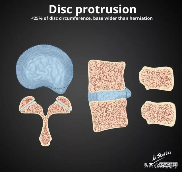 图解腰椎间盘突出,椎间盘髓核膨出图