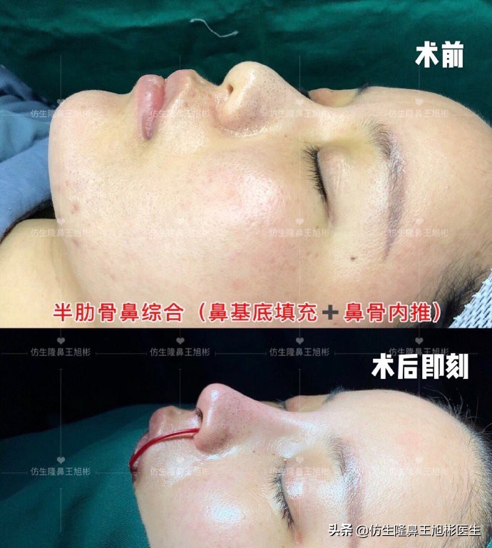 鼻头部位整形,鼻头圆钝高鼻梁整形案例