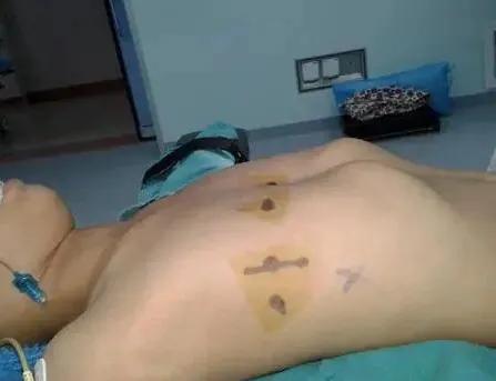 漏斗胸手术后变沟状胸,胸部饱满手术