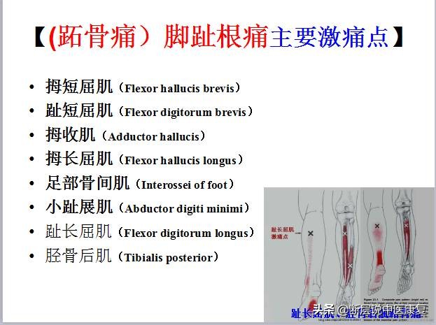 激痛点挂图,激痛点疗法笔记