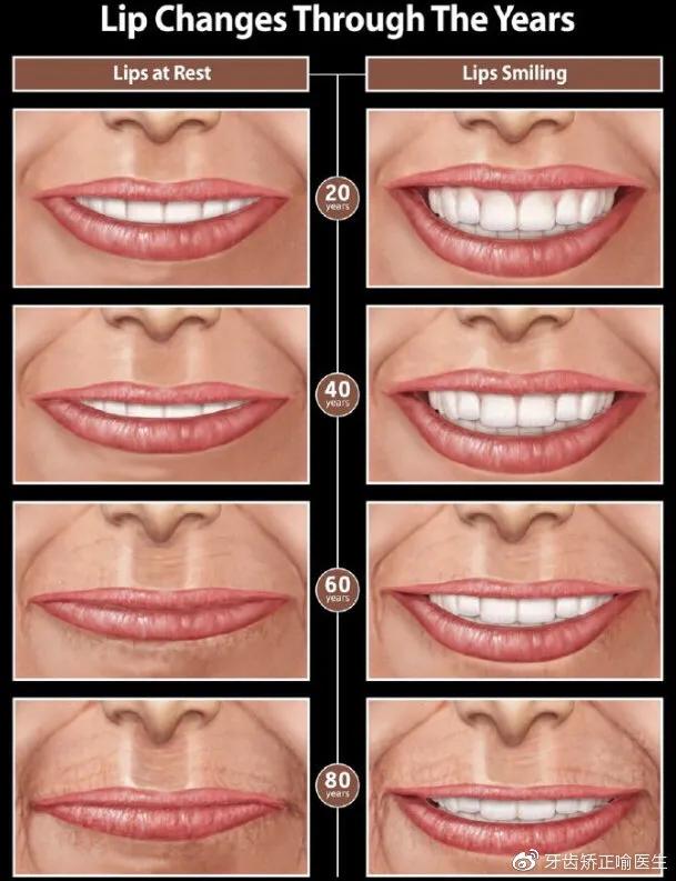 宝宝笑起来露牙龈是什么原因,牙齿矫正露牙龈笑怎么办