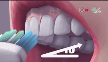 有了坏牙可以通过刷牙治疗吗,烂牙什么时候刷牙好