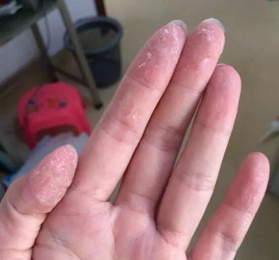 502胶水把手粘住了怎么处理,502胶水把手粘住了怎么办