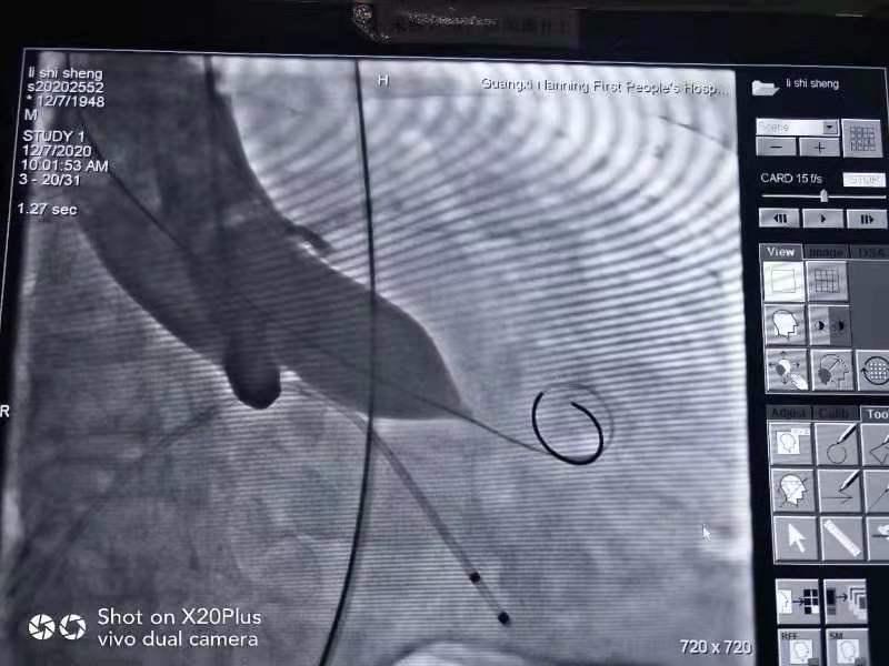南宁股骨头置换,南宁股骨头置换在哪个医院比较好