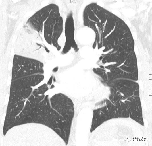 长期卧床病人肺部并发症,卧床患者肺部感染并发症