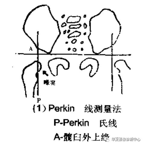 先天性髋关节脱位,先天性髋关节脱位属不属于残疾人