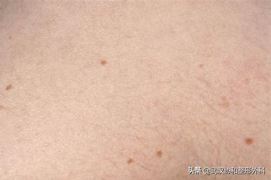 两毫米的痣医生要切,切痣医生怎么判断有没有切干净