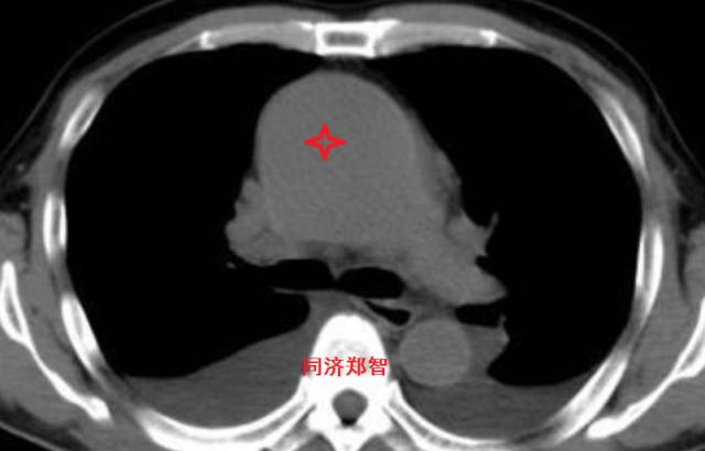 磁共振可以替代cta检查主动脉夹层,主动脉夹层cta上如何分辨真假腔